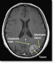 Meningioma Brain Tumor