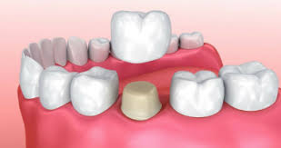 When Does Your Tooth Need A Dental Crown Meridian Id
