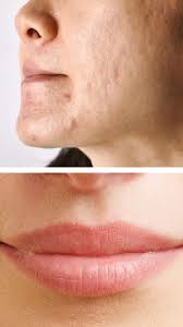 remove pigmentation around mouth