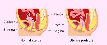 uterine prolapse symptoms ses
