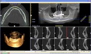 cone beam computed tomography assisted
