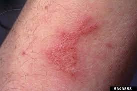 What Do Bed Bug Bites Look Like