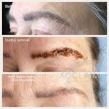 Tattoo fading methods that work. Eyebrow Tattoo Removal Arlington Microblading Removal Tx
