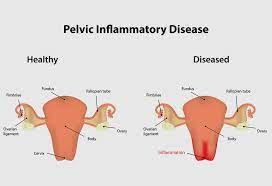 For example, chlamydia can cause pid with no symptoms. Pelvic Inflammatory Diseases Pid Reasons Symptoms Treatment