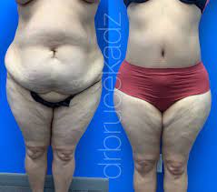 weight do you lose from a tummy tuck