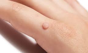 effective wart removal treatments