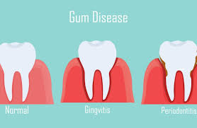 the causes of gum disease mark r