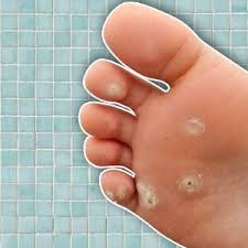 treatment for resistant plantar warts