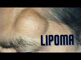 scarless lipoma treatment in ranchi