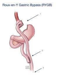 gastric byp general bariatric