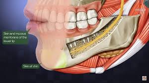 wisdom teeth nerve damage boston