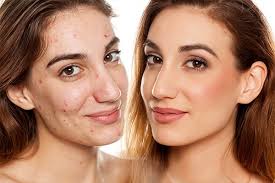 conceal pimples and acne with makeup