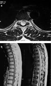 idiopathic spinal epidural lipomatosis