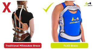 The condition is typically diagnosed in early adolescence … Everything You Ever Wanted To Know About Scheuermann S Disease From Schmorl S Nodes To Bracing To Surgery Milwaukee Brace Braces Scoliosis Brace