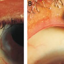 common types of benign eyelid tumors a