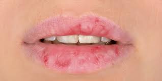 what causes dry chapped lips stop