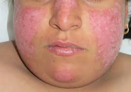 discoid lupus erythematosus causes