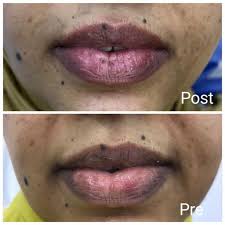 pink lips with carbon laser in hurghada