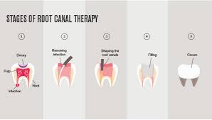Depending on your plan, root canals can fall into either the basic or major category. Root Canal Fixing Tooth Infection Hcf