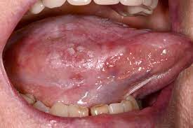 symptoms of mouth cancer nhs