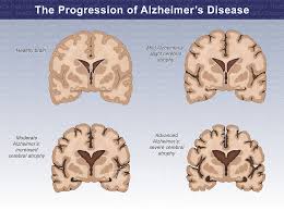 the progression of alzheimer s disease