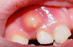 what is cyst french dental