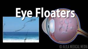 eye floaters and flashes animation