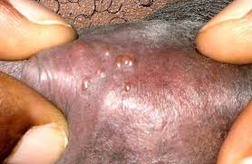 Causes, treatment, removal and pictures collection. Ingrown Hair Or Herpes How To Tell