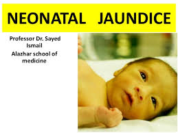 Neonatal Jaundice 2017