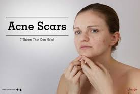 home remes for acne scars on face
