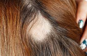 trichotillomania hair regrowth and
