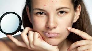 tips to treat acne breakouts in summer
