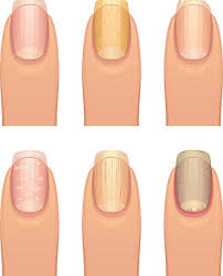 nail changes causes symptoms and