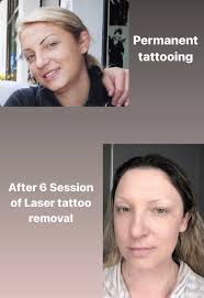 eyebrow tattoo removal sydney lash