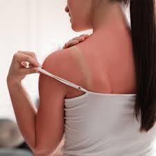 how to treat sunburn forefront