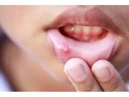 is mouth ulcer making your life