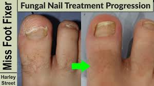fungal toenail treatment toenail