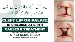 cleft lip and cleft palate in children