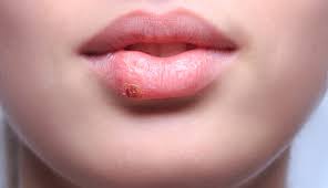 chapped lips with chron s disease