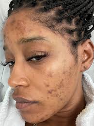 This is one movie where. Keke Palmer Says Tyler Perry Offered To Pay For A Dermatologist For Her Traumatic Skin Condition People Com