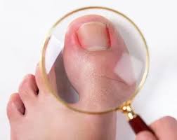 ingrown toenails for ventura county