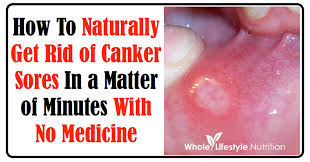 naturally get rid of canker sores