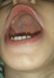 submucous cleft palate babycenter