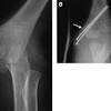 A medial epicondyle fracture is an avulsion injury of the attachment of the common flexors of the forearm. Https Encrypted Tbn0 Gstatic Com Images Q Tbn And9gcrxders859rytejd62ayuuw2gf4jbzbwgqfop7hlscifkdqgdrf Usqp Cau