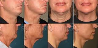 non surgical skin tightening treatment