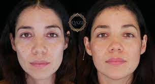 how long does juvederm last