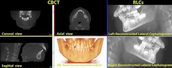 sing mandibular changes in