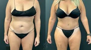 tummy tuck surgery in the woodlands