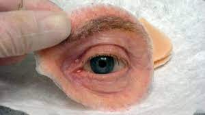 eye prosthesis ocular prosthesis