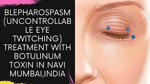blepharospasm uncontrollable eye